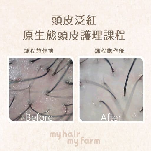 頭皮問題、頭皮管理、頭皮護理
